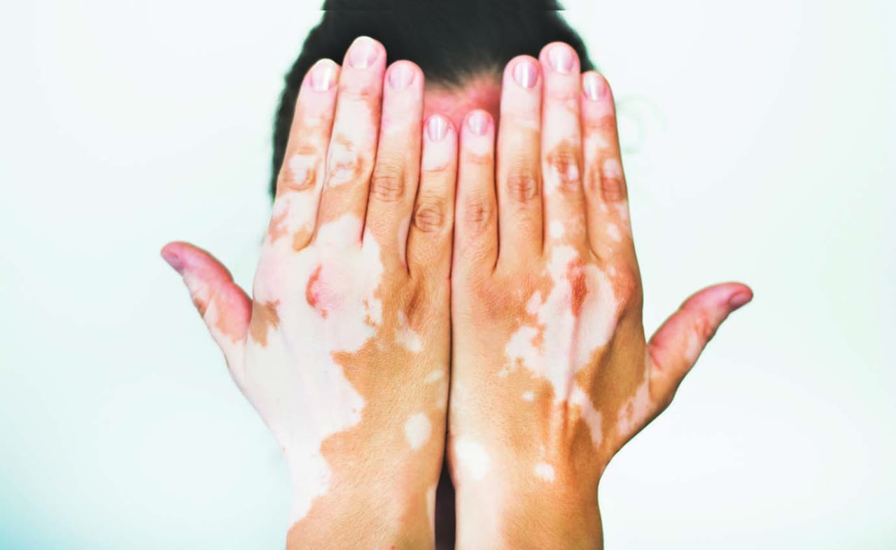 vitiligo